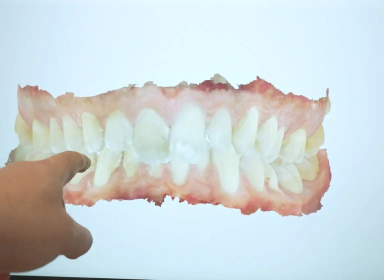 how to treat gum disease