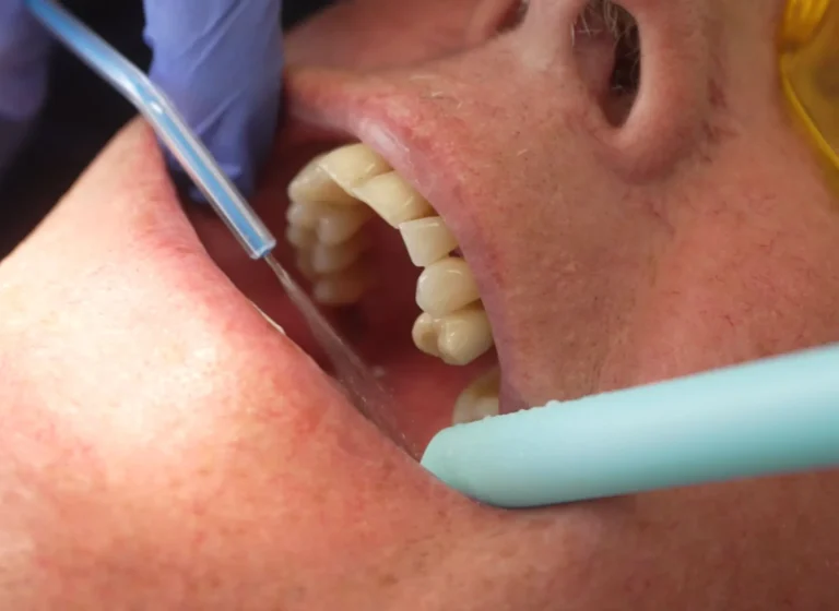 can a root canal be done in one visit